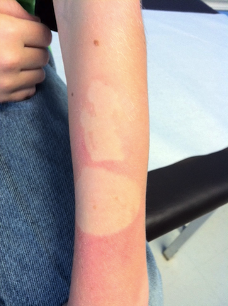 Don't be rash: tidbits about Lyme disease, poison ivy, and sunburn