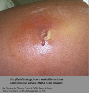 MRSA: Myths and Reality - Two Peds in a Pod®