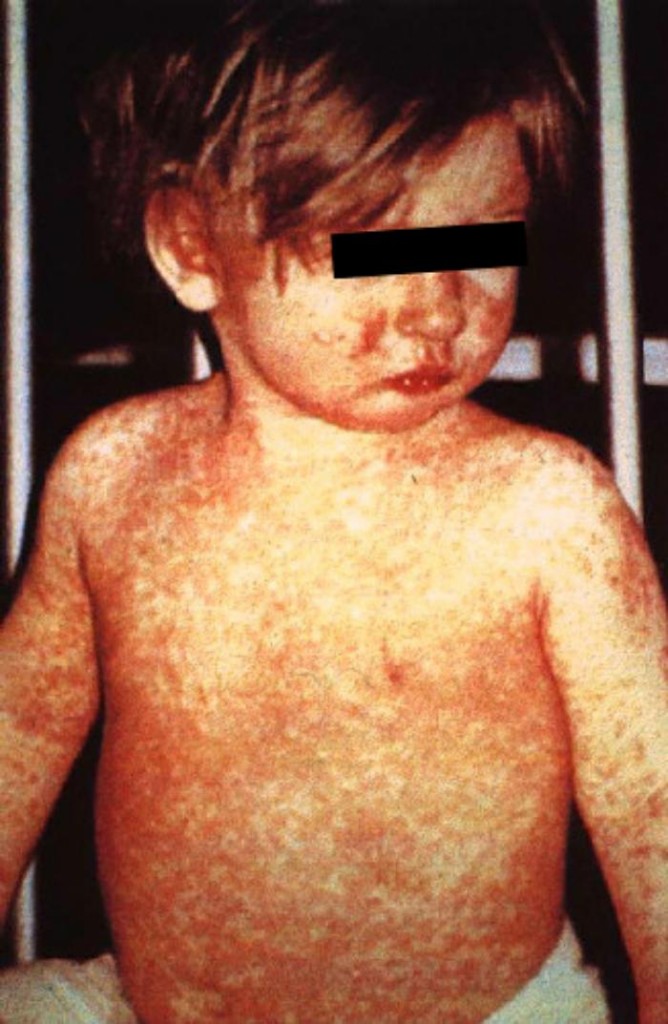 recognize measles