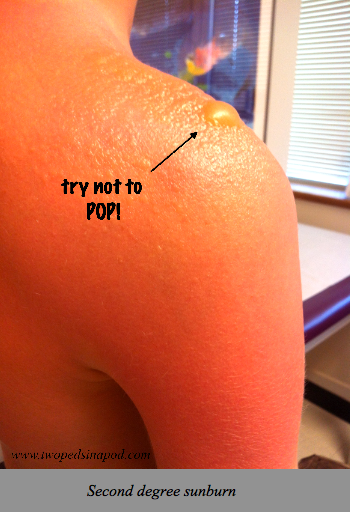 Sunburn and Sunscreens: your burning questions answered - Two Peds