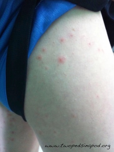 Note that the hot tub folliculitis rash is worse under the area of the swimming suit at the top of the thigh. 