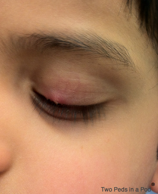 stye photo